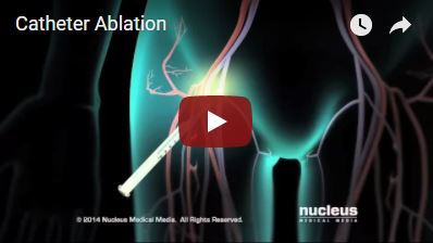 Catheter Ablation.JPG